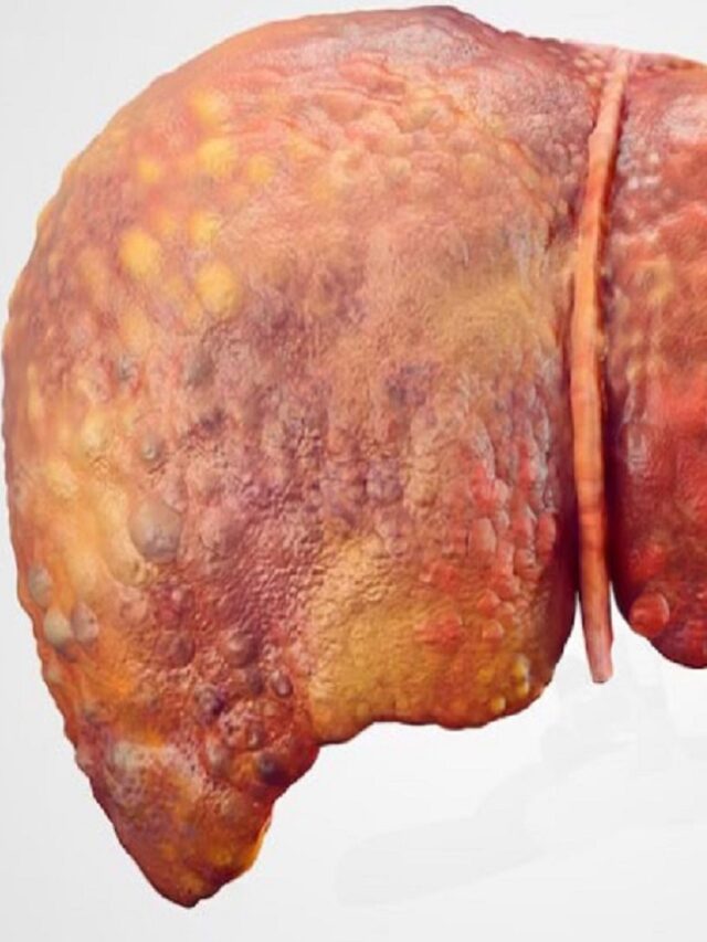 Non-Alcoholic Fatty Liver