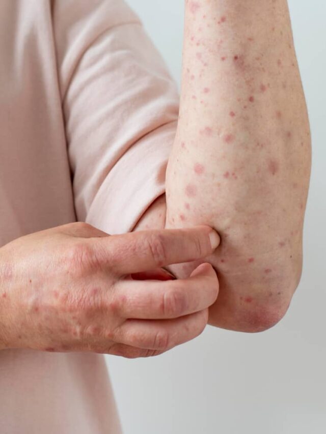 Mpox Symptoms