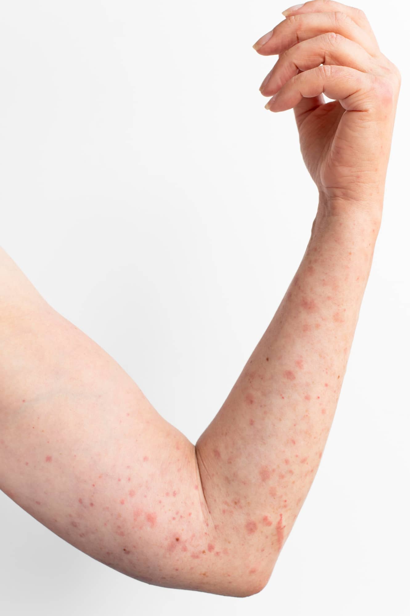 Kids With Eczema May Need More Allergy Testing, Study Says