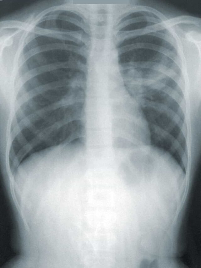 10 Warning Symptoms of Pneumonia